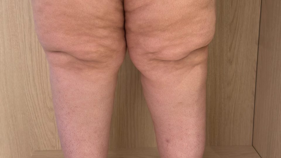 Ilustração do tema lipedema, acúmulo de gordura nas pernas
